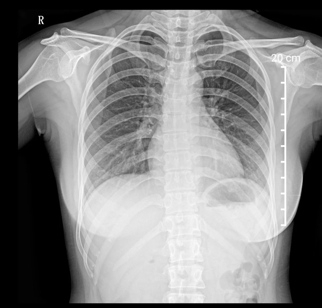 胸部X光檢查.jpg 胸部X光檢查.jpg